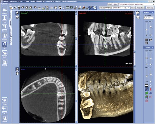 XOGRAPH__1293101519_RXS_Impacted_0109_low